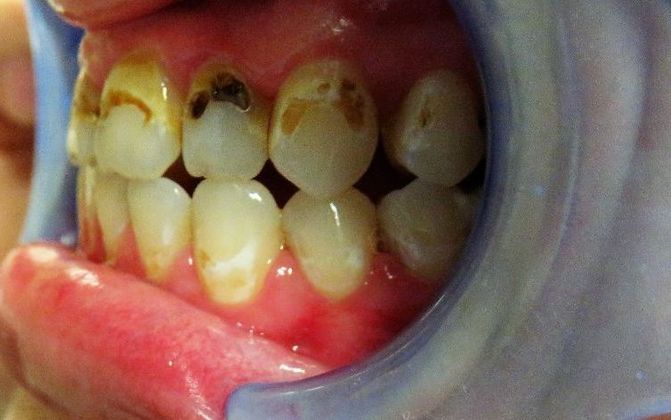 Dental Crowns: Case 8 - Before