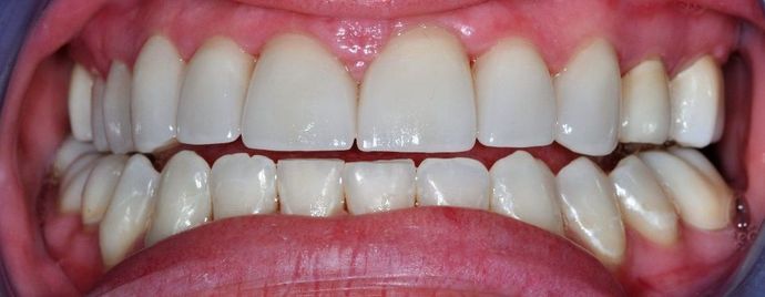 Dental Crowns Case 8 - After