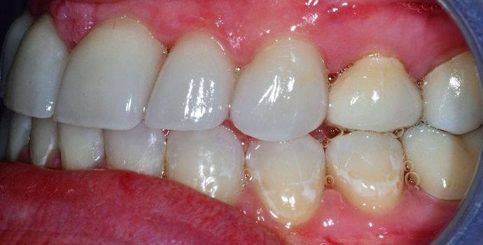 Dental Crowns: Case 8 - Before