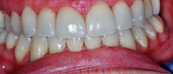 Dental Crowns: Case 8 - After
