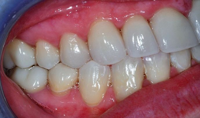 Dental Crowns: Case 8 - After