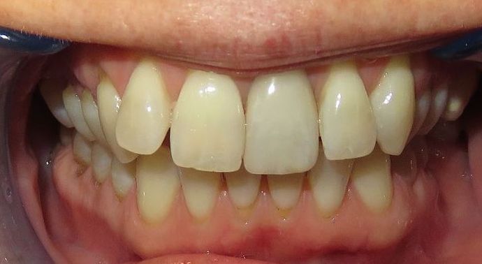Veneers Case 5 - Before