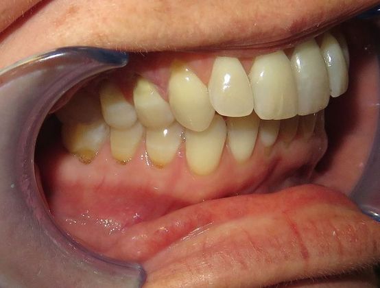 Veneers: Case 5 - Before