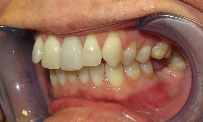 Veneers: Case 5 - Before