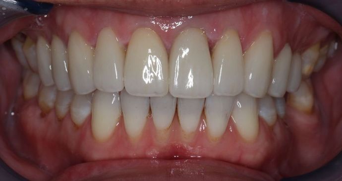 Veneers Case 5 - After