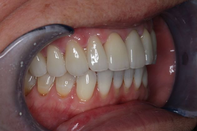 Veneers: Case 5 - After