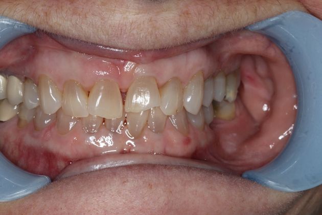 Veneers: Case 6 - Before