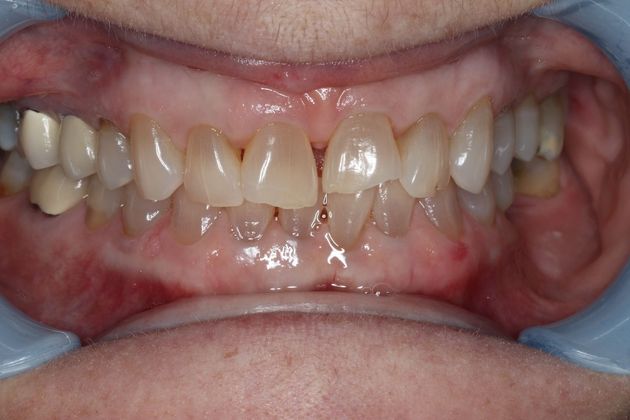 Veneers Case 6 - Before