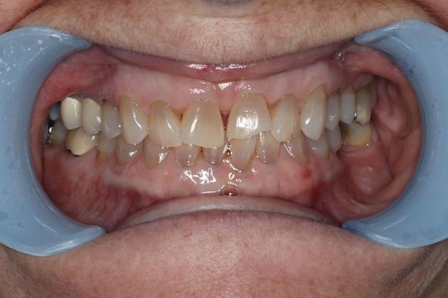 Veneers: Case 6 - Before