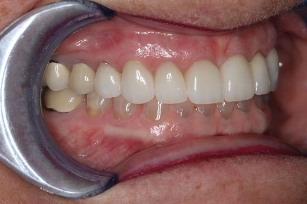 Veneers: Case 6 - After