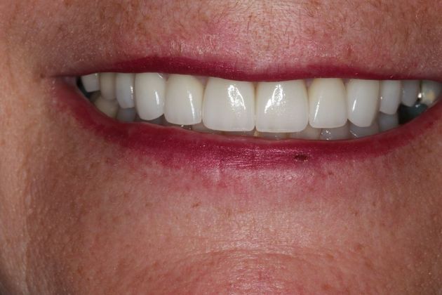 Veneers: Case 6 - After