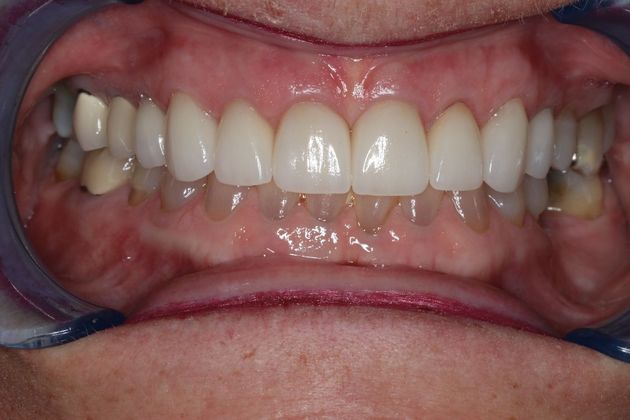 Veneers Case 6 - After