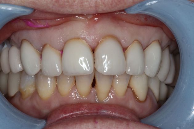 Veneers Case 7 - Before