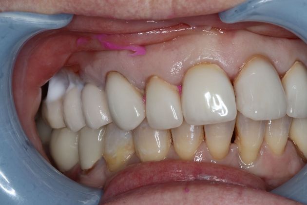 Veneers: Case 7 - Before
