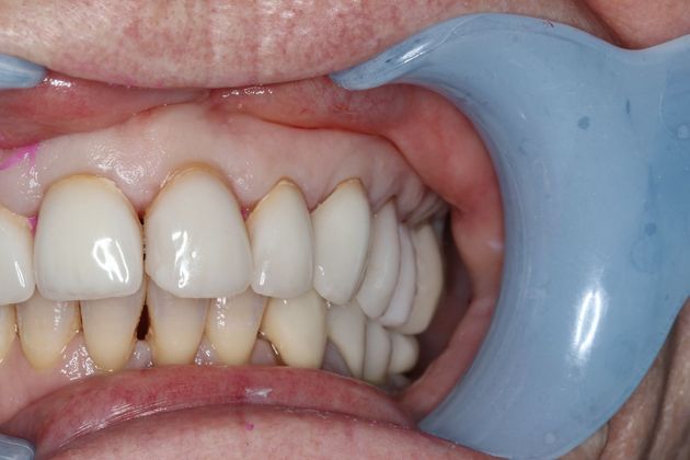 Veneers: Case 7 - Before