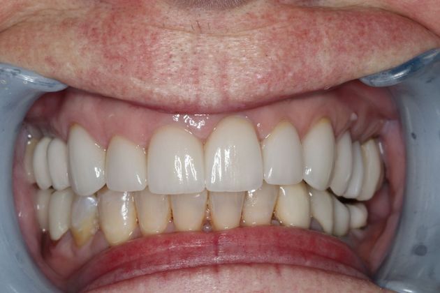 Veneers Case 7 - After