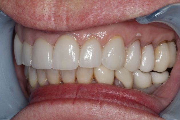 Veneers: Case 7 - After