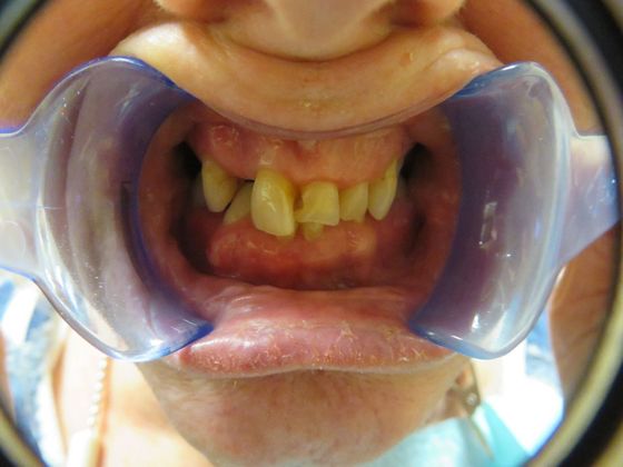 Teeth In A Day: Case 1 - Before