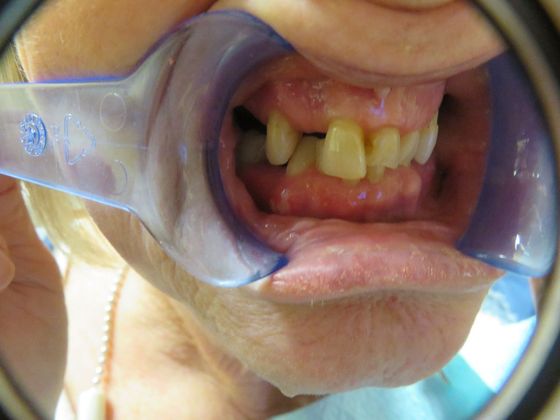 Teeth In A Day: Case 1 - Before