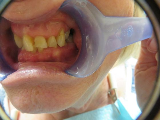 Teeth In A Day: Case 1 - Before