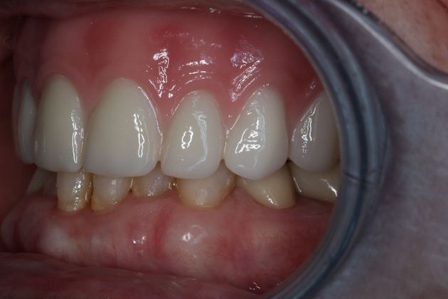 Teeth In A Day: Case 1 - After