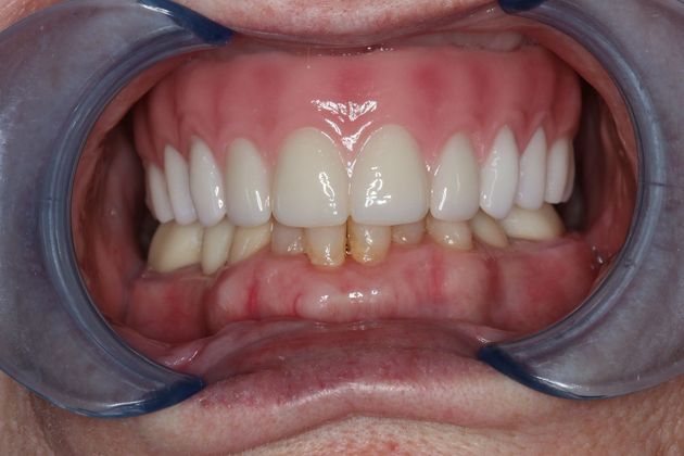 Teeth In A Day Case 1