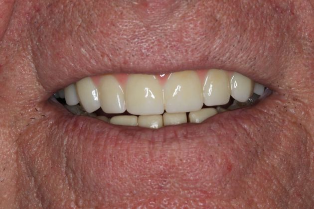 Teeth In A Day Case 2 - Before