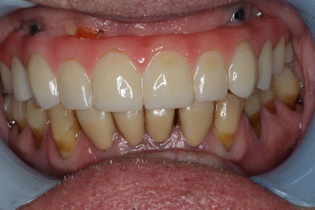 Teeth In A Day Case 2 - After