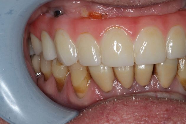 Teeth In A Day: Case 2 - Upper Arch