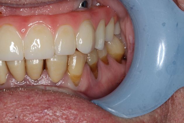 Teeth In A Day: Case 2 - Upper Arch