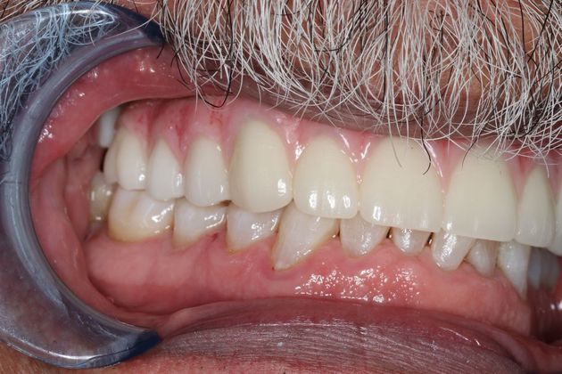 Teeth In A Day: Case 3 - Upper Arch