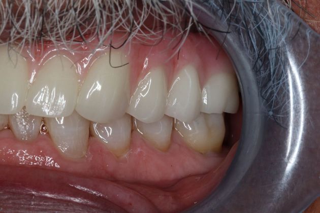 Teeth In A Day Case 3 - After