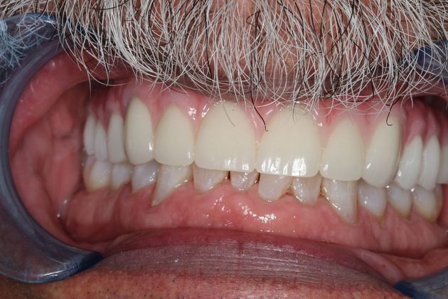 Teeth In A Day Case 3 - Before