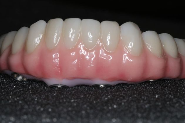 Teeth In A Day: Case 4 - Restoration