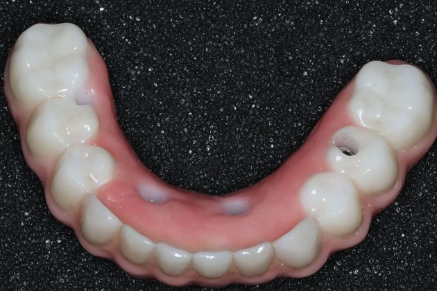 Teeth In A Day: Case 4 - Restoration