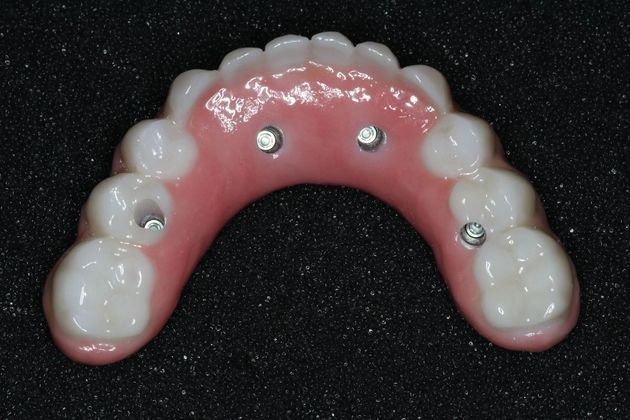 Teeth In A Day: Case 4 - Restoration