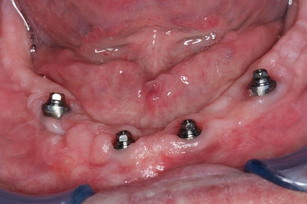 Teeth In A Day Case 4 - Before