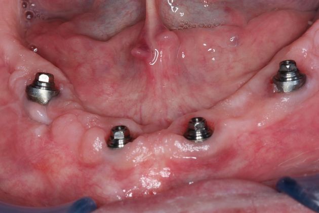 Teeth In A Day: Case 4 - Lower Arch