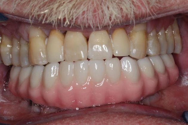 Teeth In A Day: Case 4 - Lower Arch