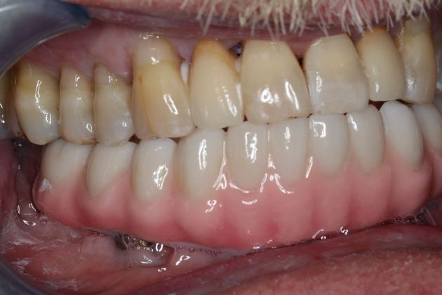 Teeth In A Day Case 4 - After