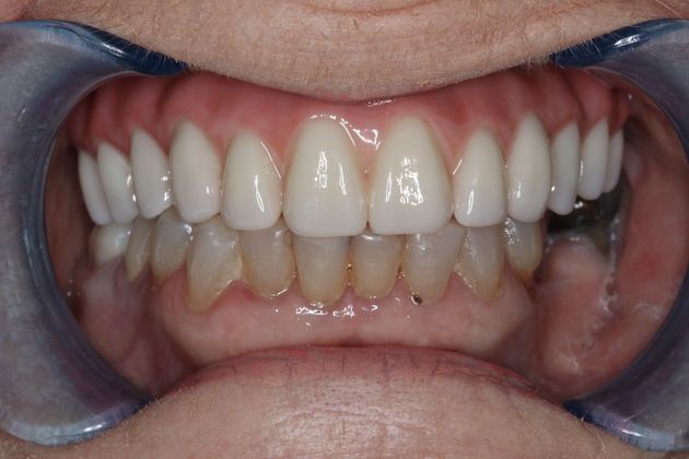 Teeth In A Day Case 5 - Before