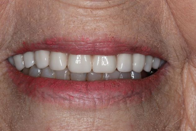 Teeth In A Day Case 5 - After