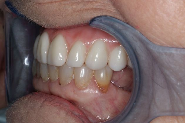 Teeth In A Day: Case 5 - Upper Arch