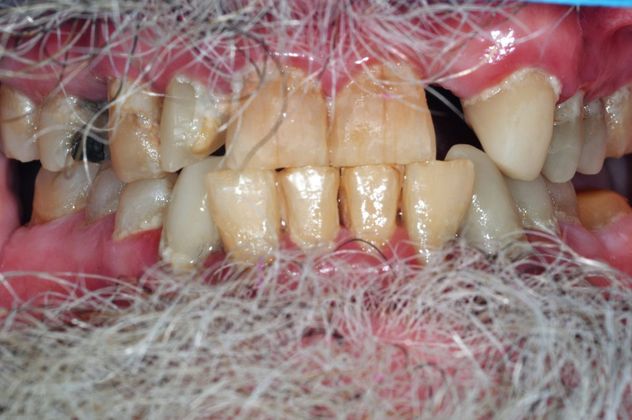 Teeth In A Day: Case 6 - Before