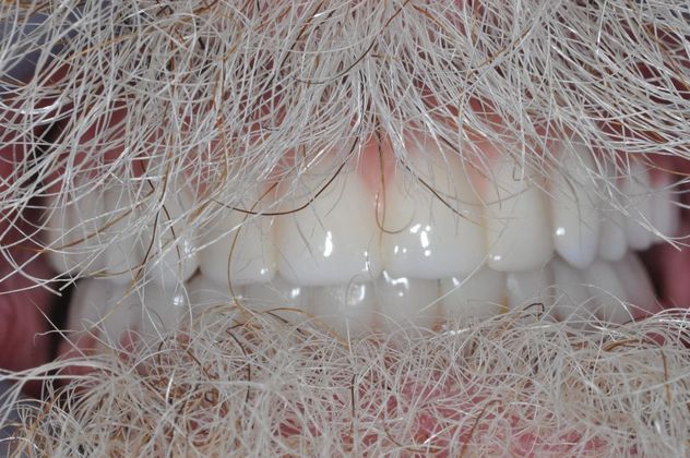 Teeth In A Day: Case 6 - After