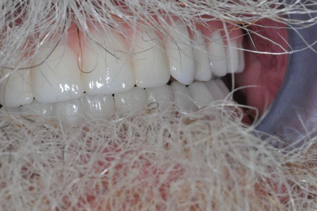 Teeth In A Day Case 6 - After