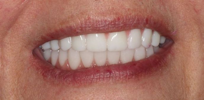 Teeth In A Day Case 7 - After