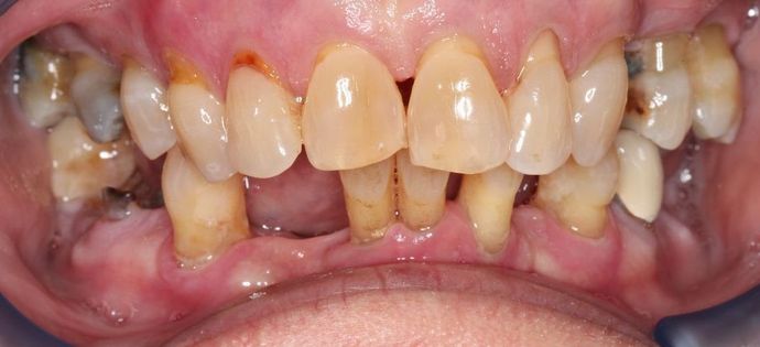 Teeth In A Day Case 7 - Before