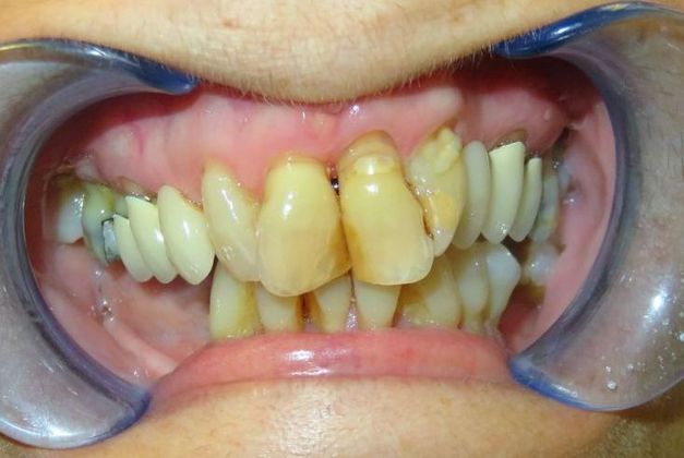 Teeth In A Day Case 8 - Before