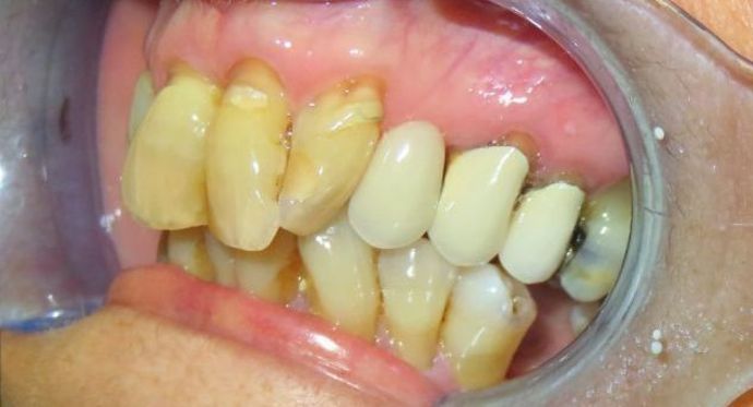 Teeth In A Day: Case 8 - Before